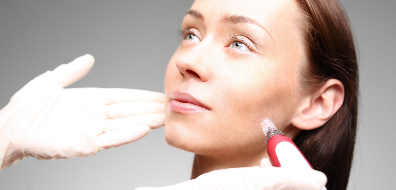 Microneedling treatment