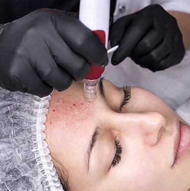 Microneedling
